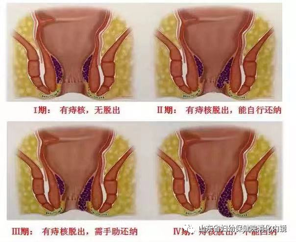 不开刀治痔疮，内痔微创治疗新方法_医学界-助力医生临床决策和职业成长