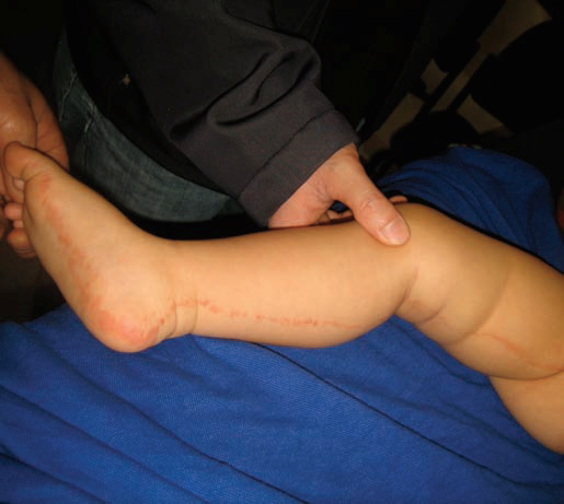 这种长成一条线的皮肤病 你知道是什么吗 医学界 助力医生临床决策和职业成长