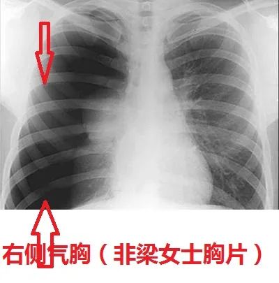 女子咳嗽 差点死了 全因医生犯了这个错误 医学界 助力医生临床决策和职业成长