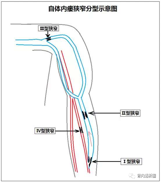 血透管路示意图图片