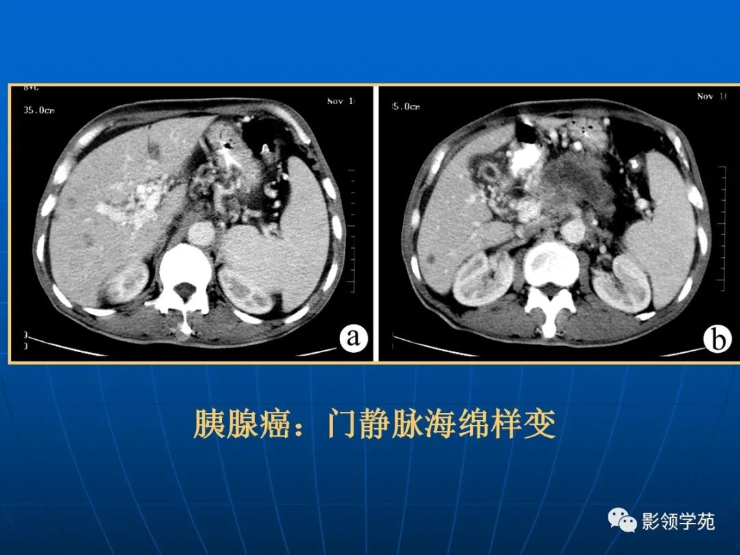 非功能性胰島細胞瘤術後復發