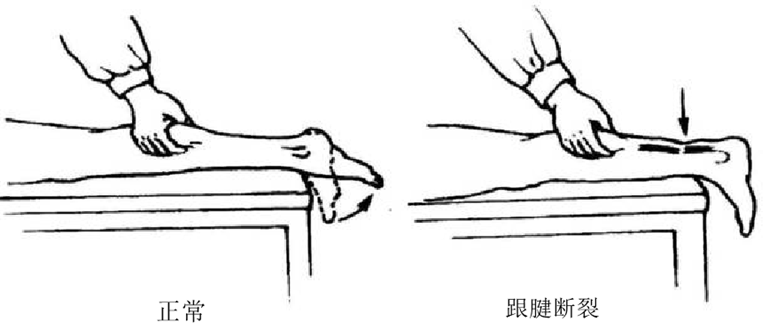 查体:跟腱连续性中断,局部凹陷,跖屈力量明显减弱,提踵试验阳性