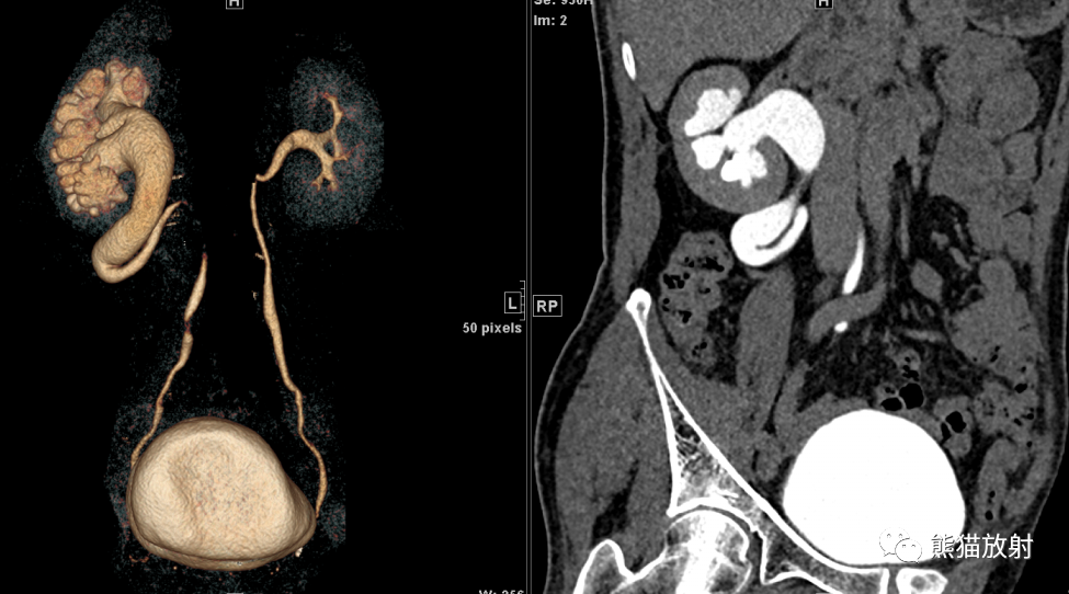 ct输尿管图像怎么看图片