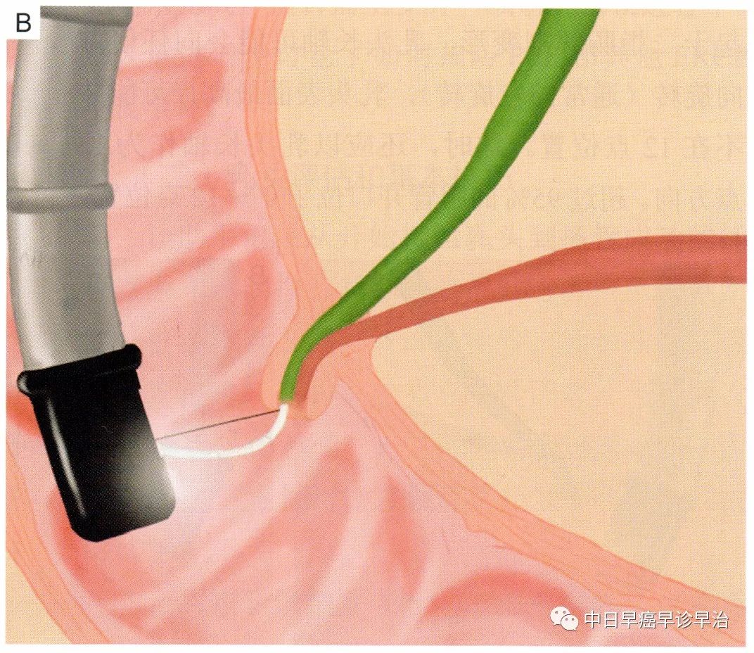 ercp:针状刀括约肌预切开术和nks技巧_医学界-助力医生临床决策和职业