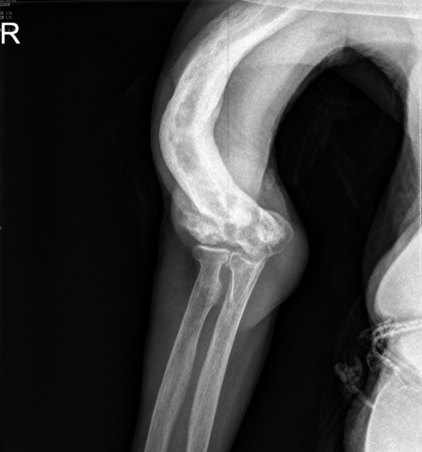 高龄女性反复骨折 严重驼背 上臂弯曲 什么情况 医学界 助力医生临床决策和职业成长