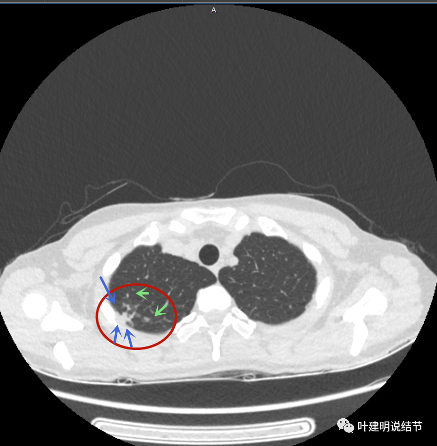 有衛星灶(綠色箭頭),鄰近胸膜明顯增厚,且模糊,邊不清病灶鄰近胸膜