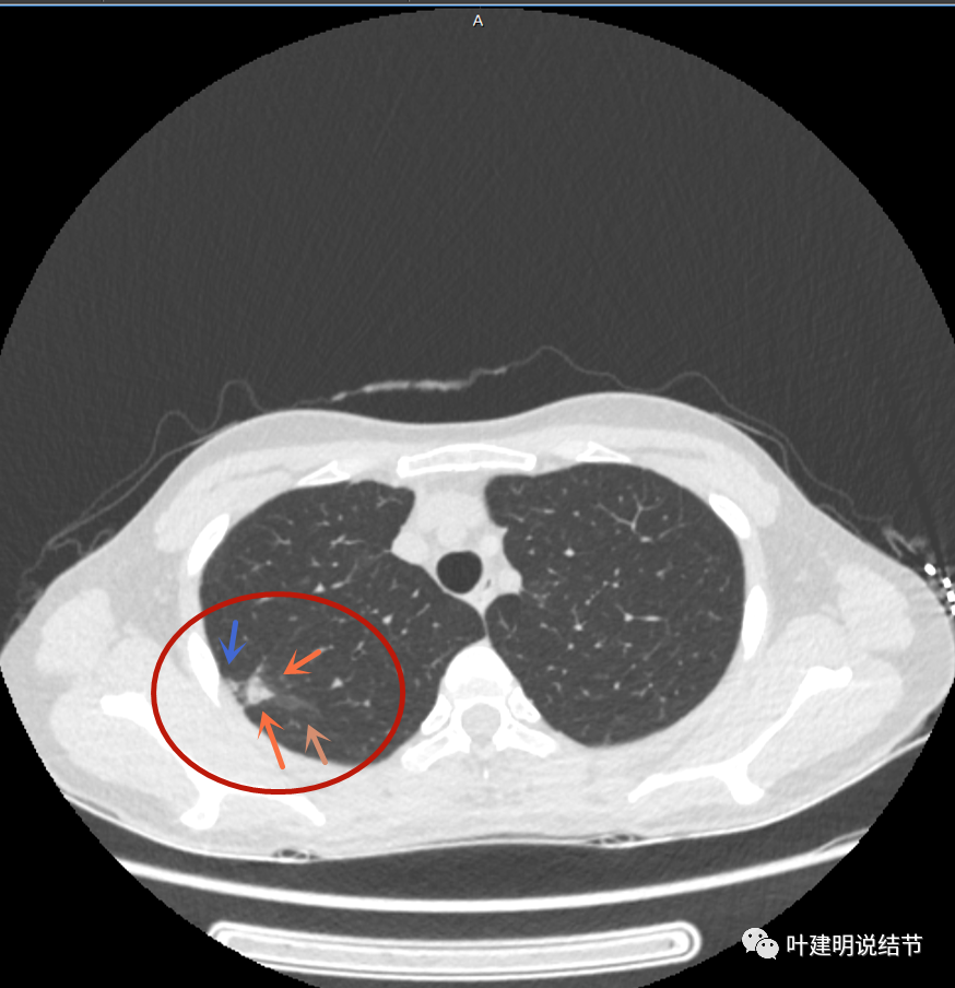 问诊分析:疑难病例-这样的肺实性空洞结节会是什么性质?