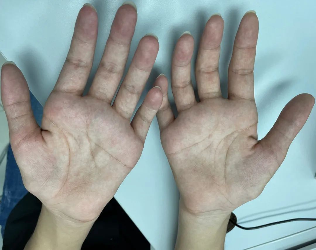 平山病——团队协作的力量_医学界-助力医生临床决策和职业成长