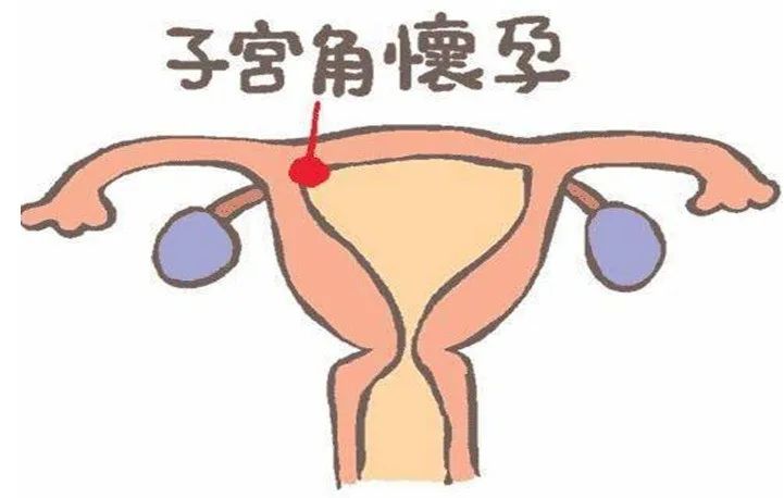 子宫角怀孕图片