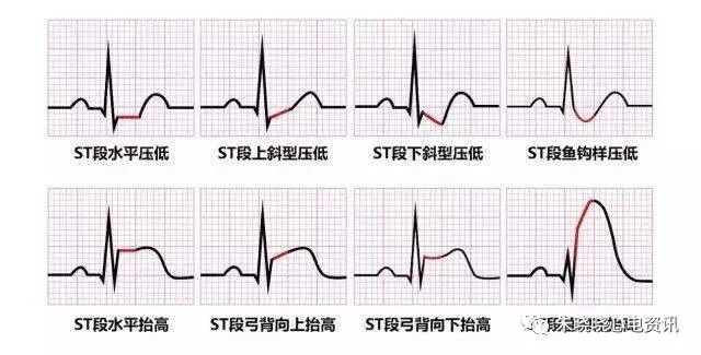 急性st 段抬高型心肌梗死的16项指标,你都知道吗