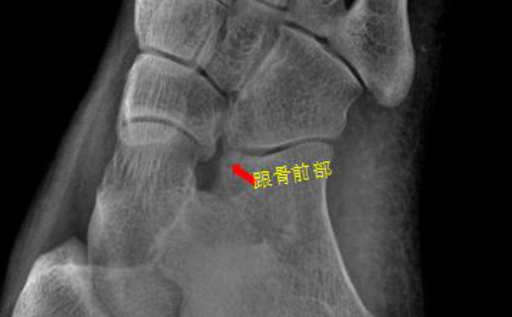 用18个实例和你说9个常见部位的骨折如何诊断 医学界 助力医生临床决策和职业成长