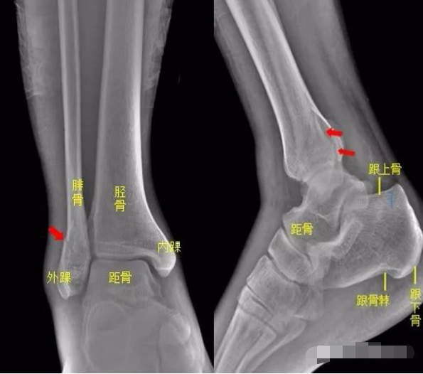 用18个实例和你说9个常见部位的骨折如何诊断 医学界 助力医生临床决策和职业成长