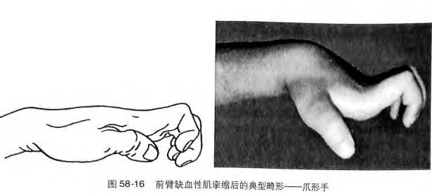 缺血性肌挛缩( ischemic contracture):是骨折最严重的并发症之一,是