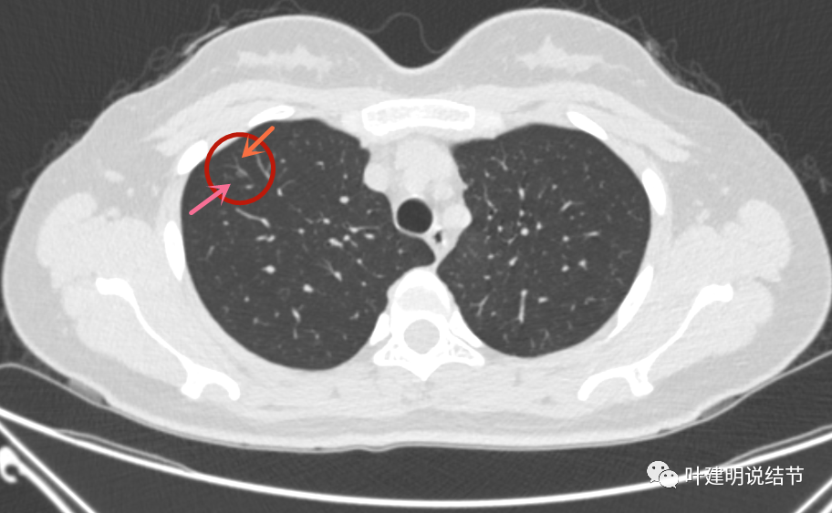问诊仅30岁的女子两肺多达11处磨玻璃结节该干预
