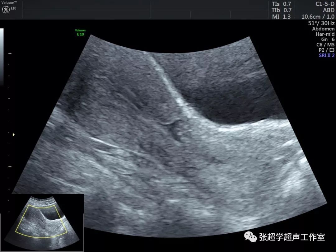 超详解读:子宫疤痕憩室的超声评估