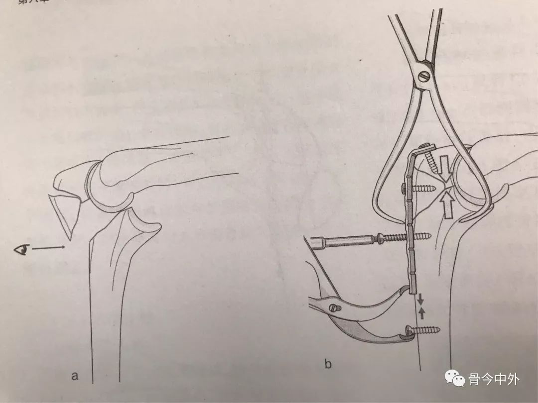 怎样才能做好尺骨鹰嘴骨折的张力带固定?