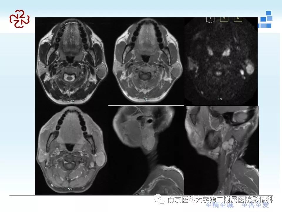 腮腺磁共振解剖图片