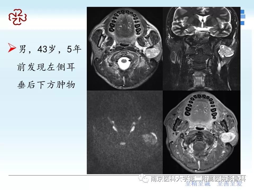 腮腺腺淋巴瘤图片