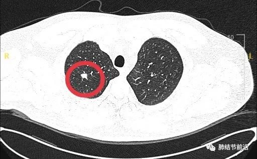 肺结节读片:这就是实性结节的「边界毛糙」