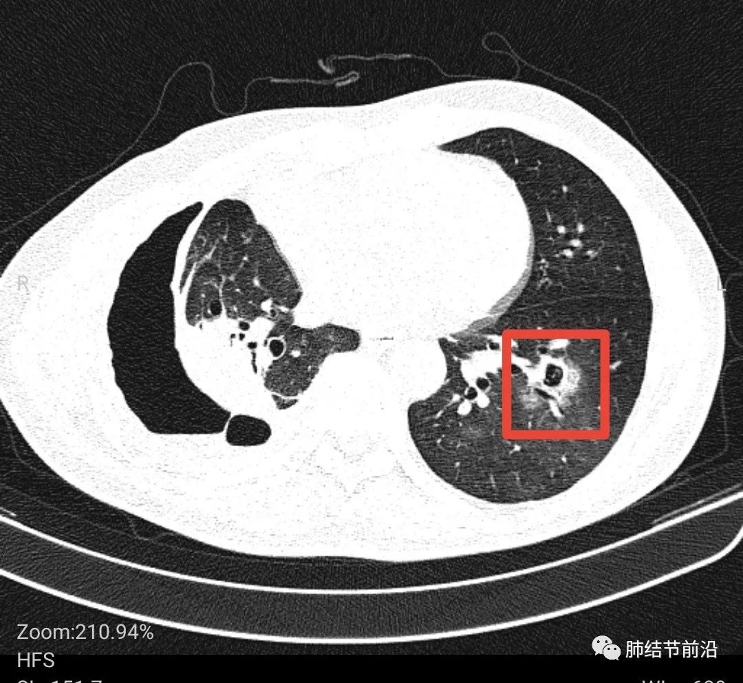 罗江区人民医院成功开展首例CT引导下肺结节术前穿刺定位术_四川在线
