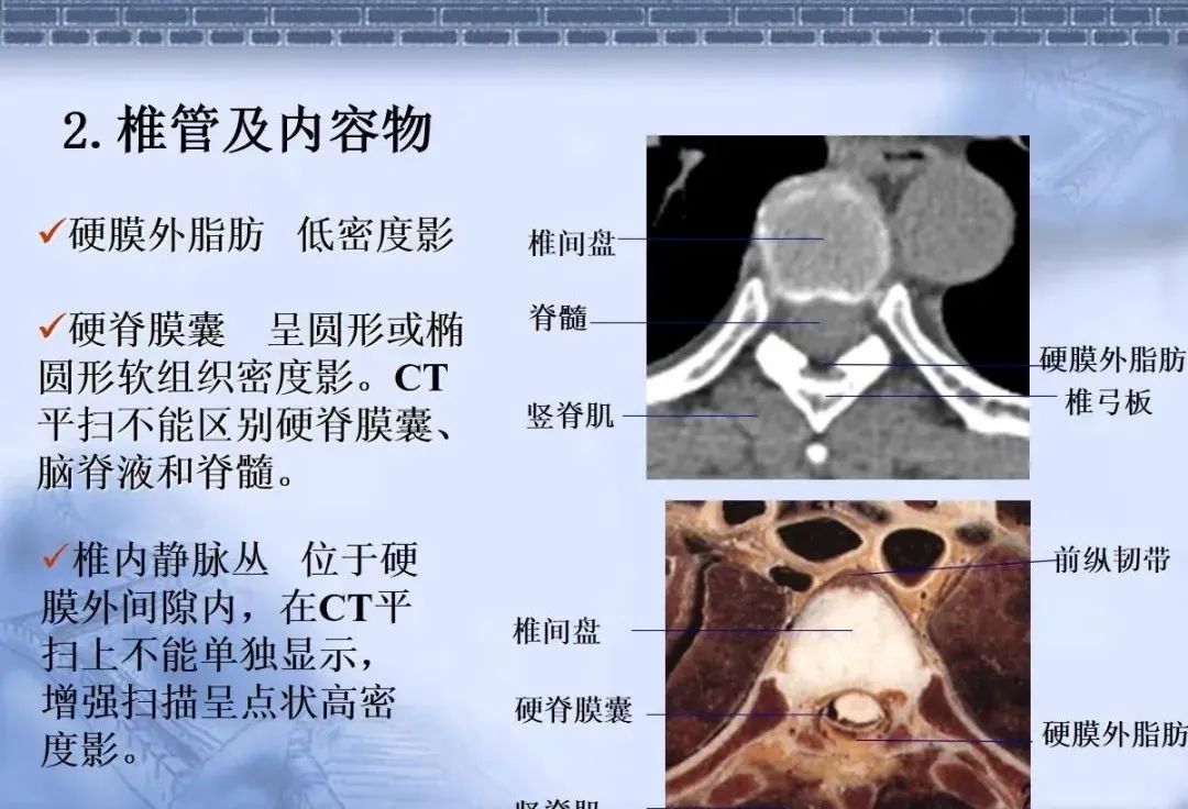 一文总结颈椎腰椎ct常见病变