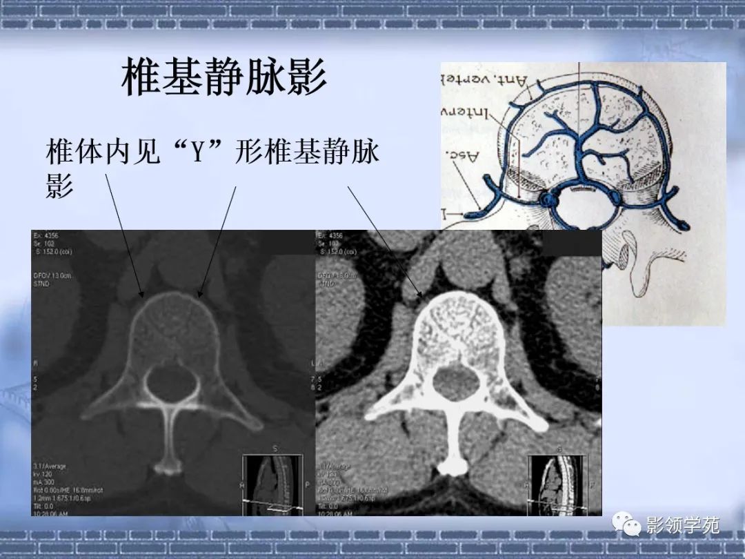 一文總結頸椎腰椎ct常見病變