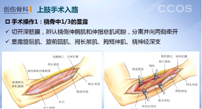 桡骨近端手术入路图图片