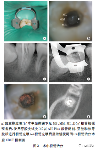 右下颌第二磨牙牛牙症伴c形根管显微治疗1例及文献回顾