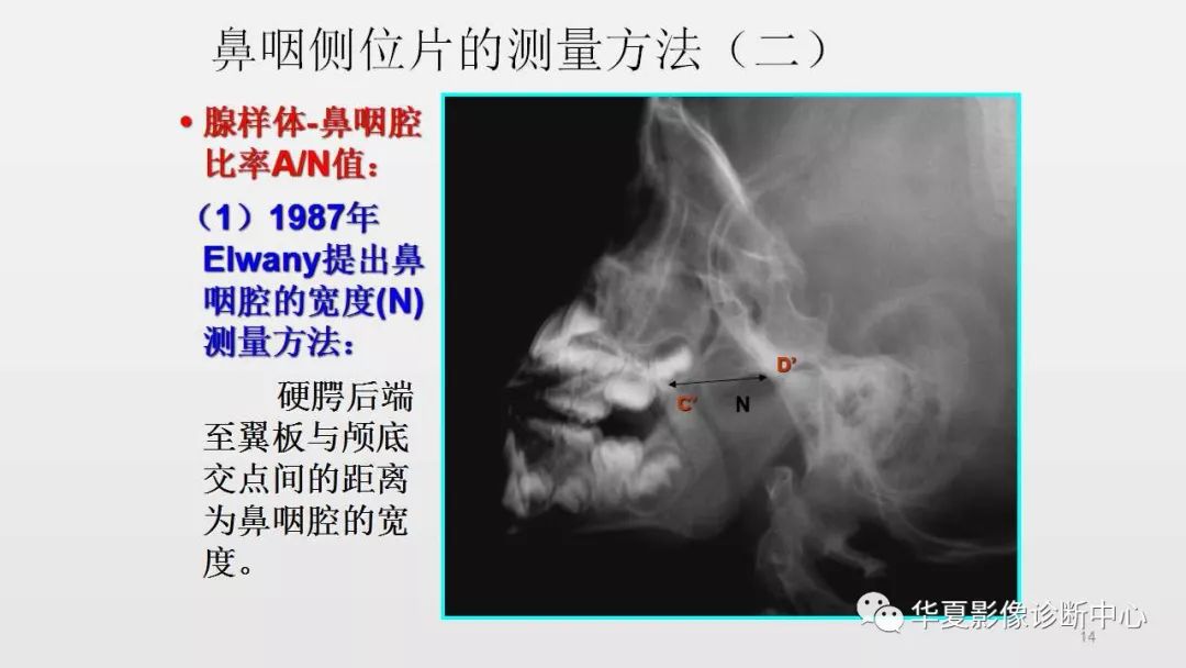 ct腺样体图像图片