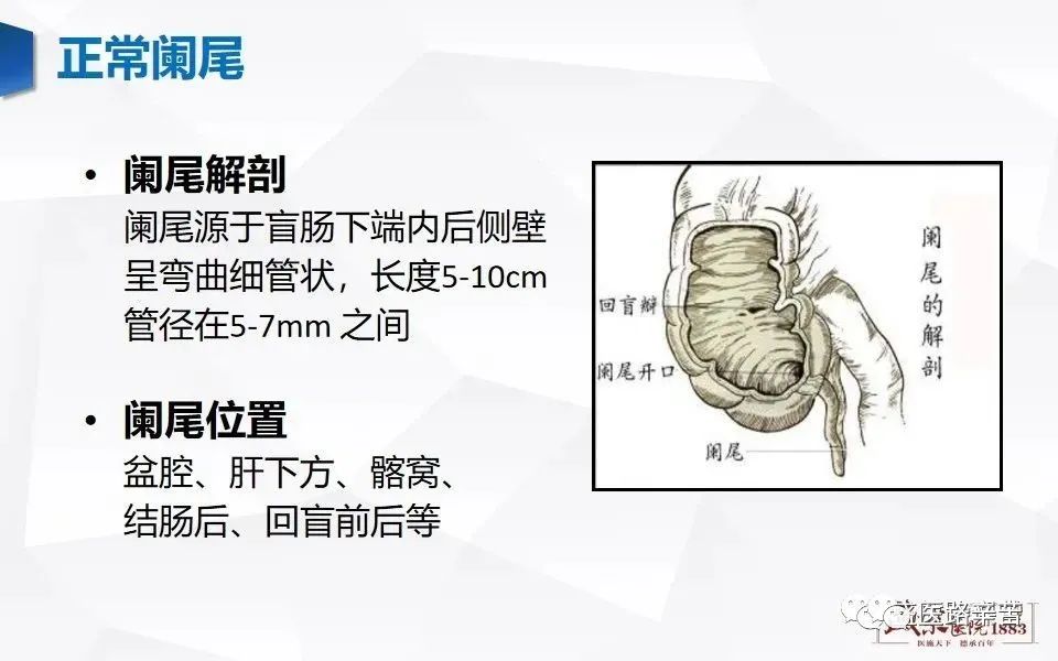 阑尾解剖,阑尾炎及周围脓肿ct表现