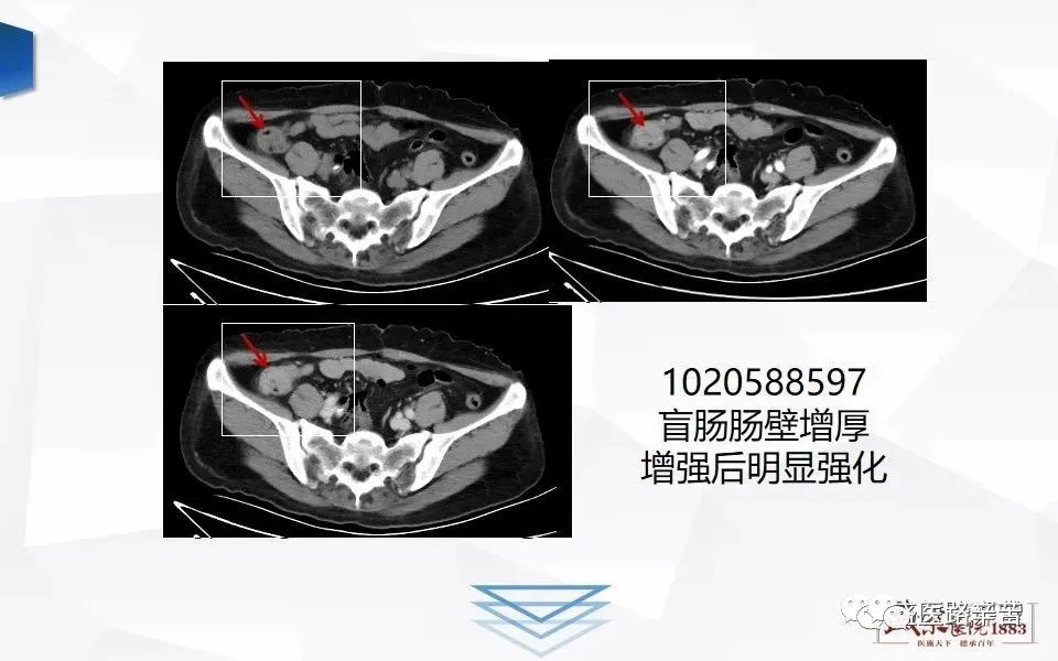 阑尾炎ct怎么看图解图片