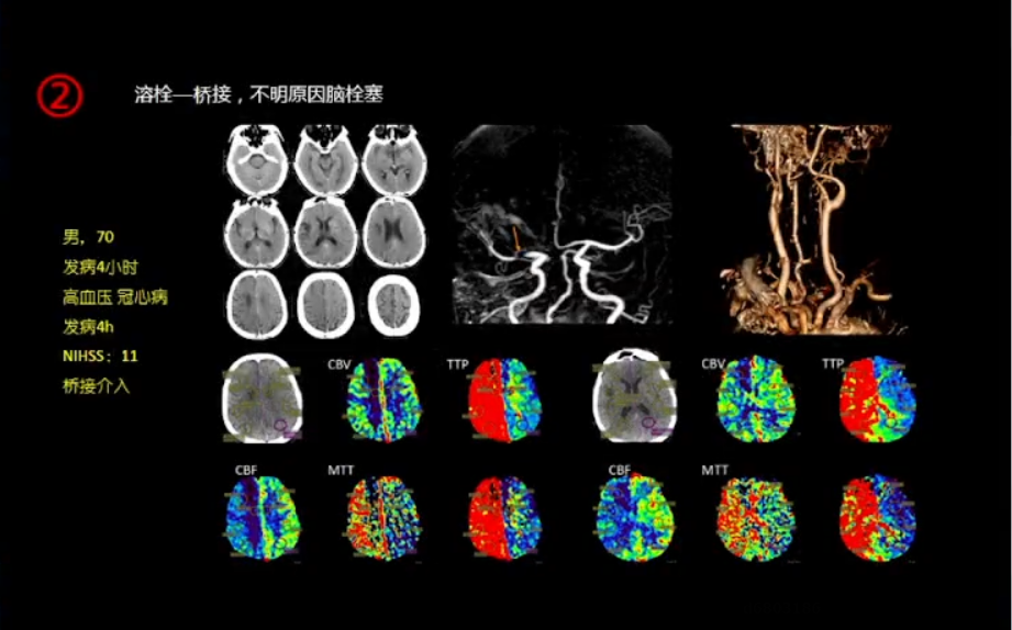 脑梗死辅助检查图片