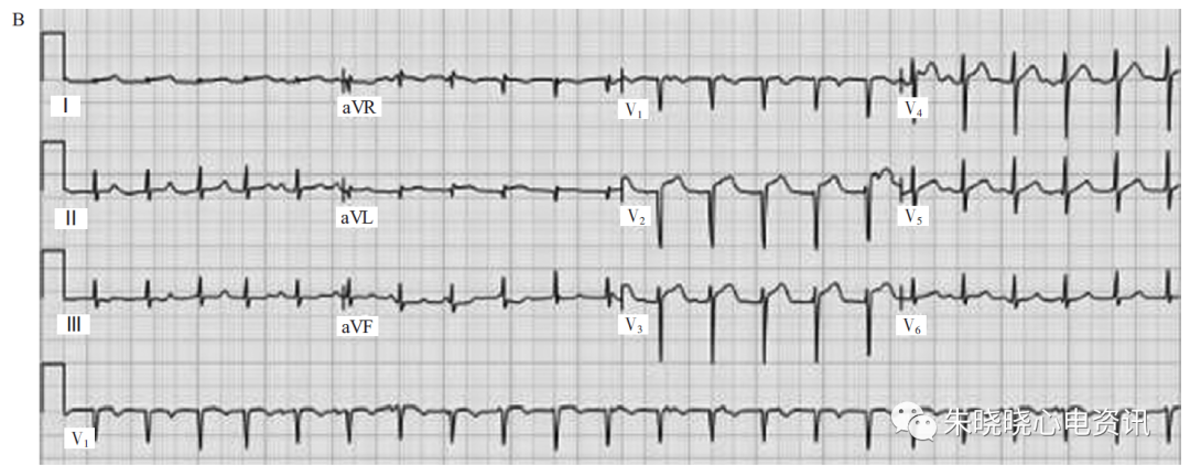 儿童心肌炎心电图图片
