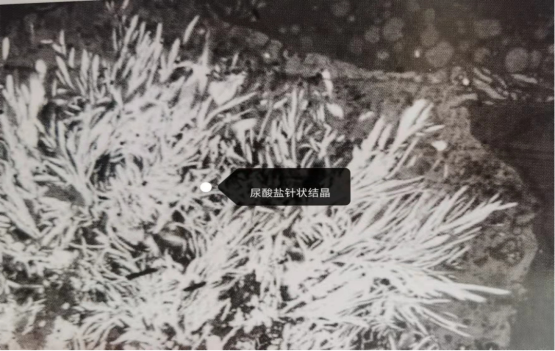 2,慢性尿酸性肾病是由于尿酸盐结晶多沉积在肾髓质引起,常见于原发性