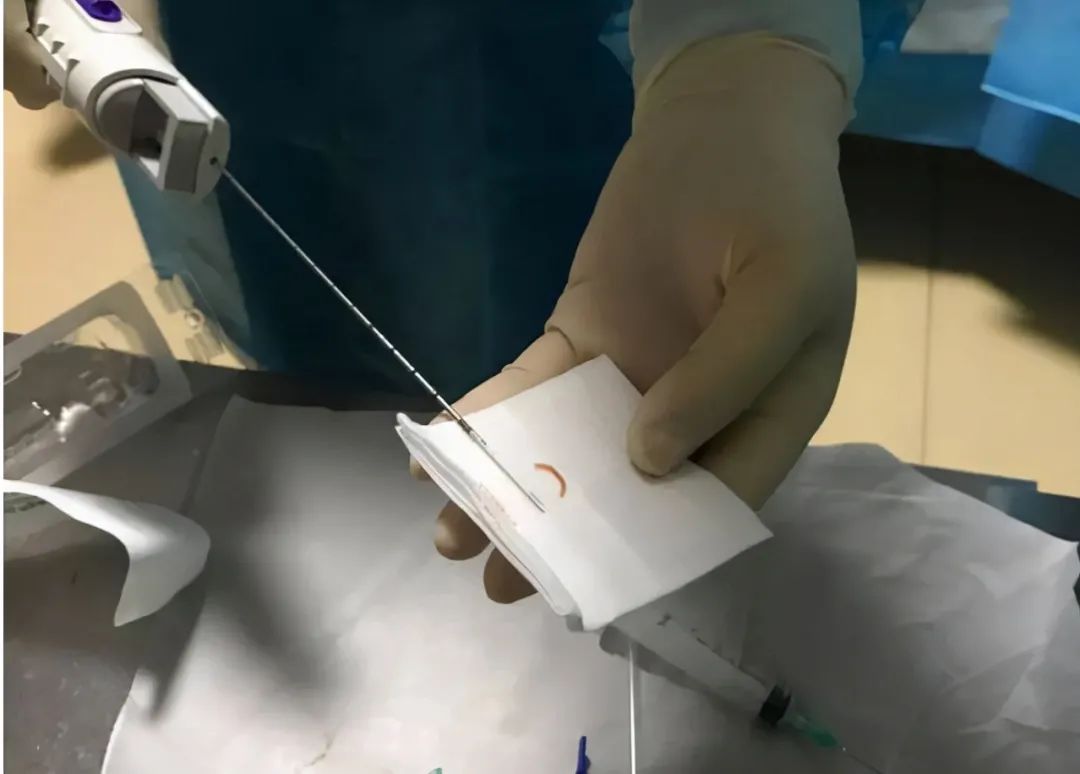 那些做了肾穿刺的肾友如今都怎样了