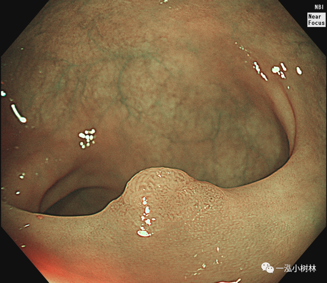 大肠息肉图片大全大图图片