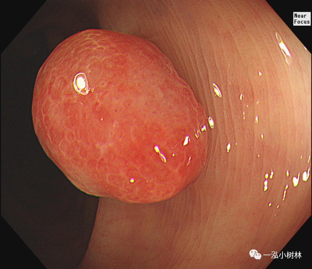 大肠息肉图片大全大图图片