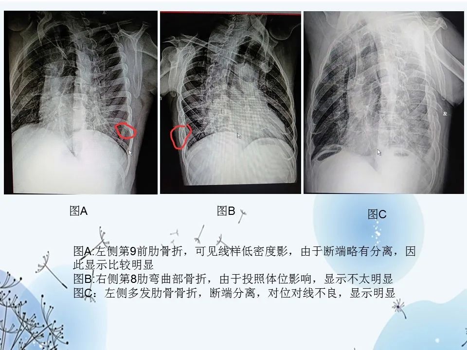 Vr与cpr联合应用在肋骨骨折诊断治疗及预后评价中的意义 医学界 助力医生临床决策和职业成长