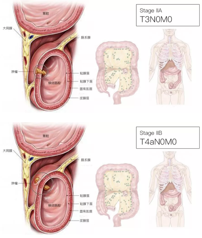 一文讀懂結直腸癌tnm分期及對應的治療方案_醫學界-助力醫生臨床決策