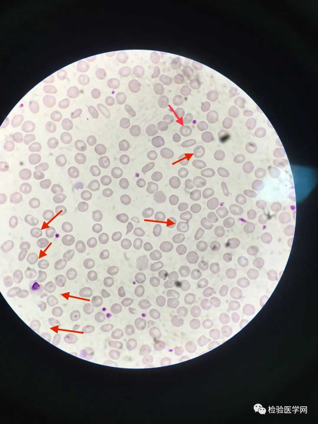 9岁的患者两年内血象一直呈现小细胞低色素性改变?正常吗?怎么考虑?
