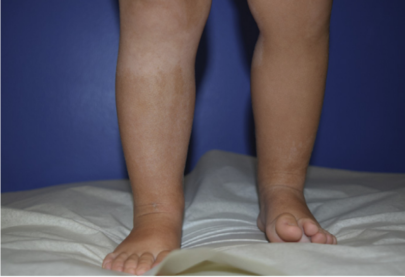 全身脱色斑2年,会是什么病?