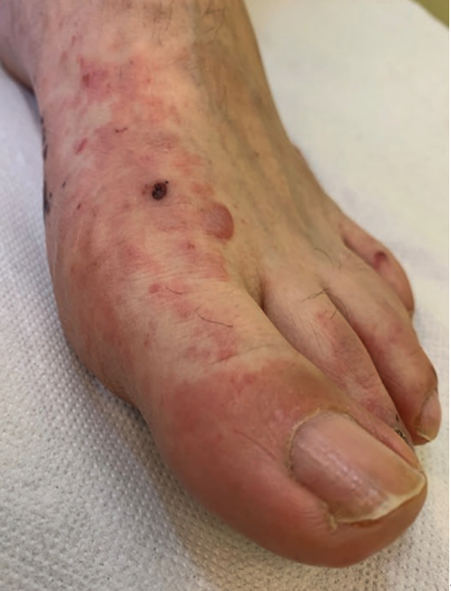病毒性皮疹 手脚图片