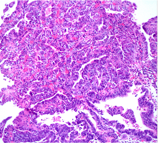 2021版csco胃癌诊疗指南病理详解,重点关注分子分型_医学界-助力医生