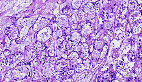 卵巢透明细胞癌的诊断与鉴别诊断小结