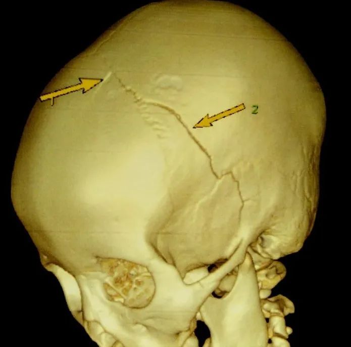 颅骨骨折的影像征象