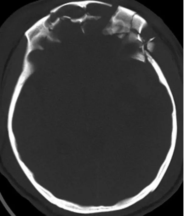 颅骨骨折ct图片大全图片