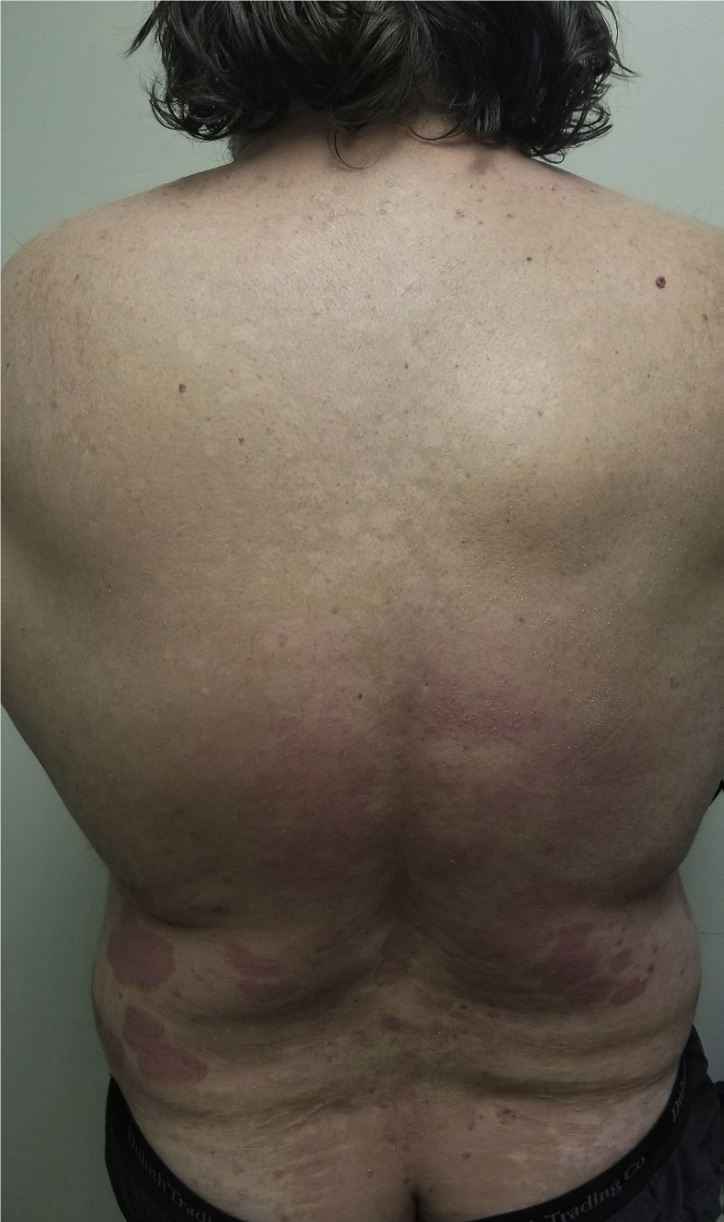 使用生物制剂后的泛发性皮损 会是什么病 看图诊断 医学界 助力医生临床决策和职业成长