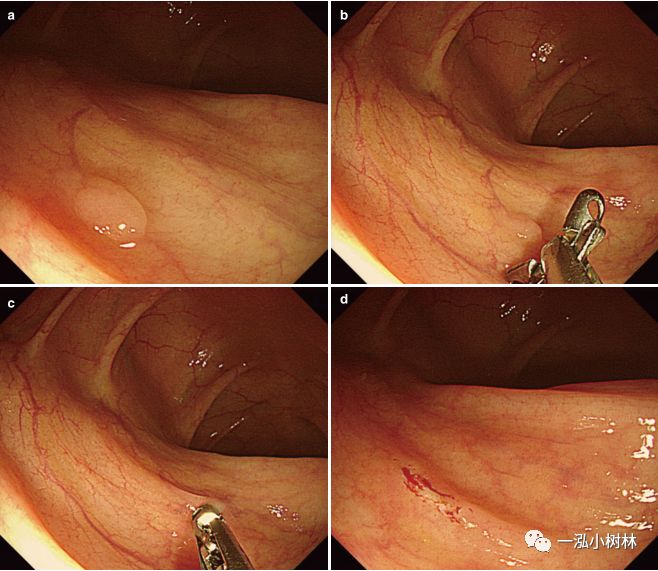 结肠息肉切除术的个人体会与认知_医学界-助力医生临床决策和职业成长