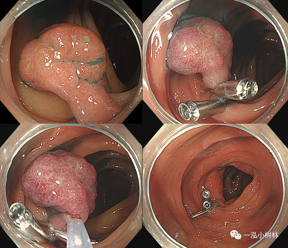 肠息肉切除过程图图片