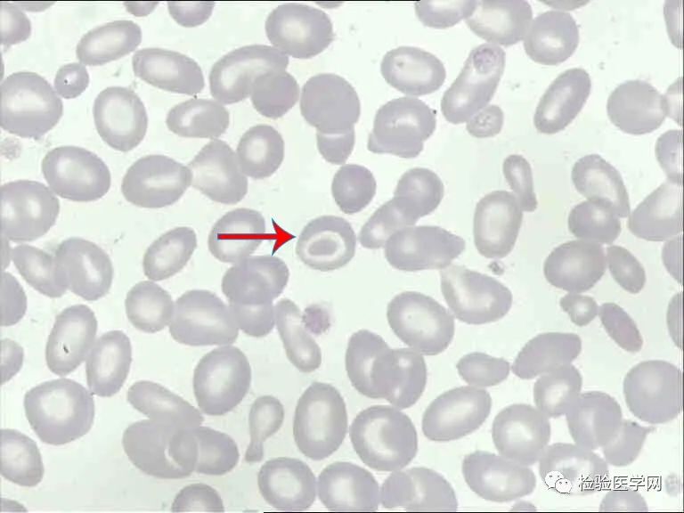 血压:147/92mmhg,轻度贫血貌,全身皮肤无黄染,巩膜轻度黄染,咽不红